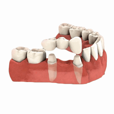 RCT (Front Tooth)